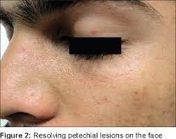 When this is the cause you have simply caused damage to your capillary blood vessels. Post Vomiting Purpura Semantic Scholar