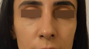 Rinoplastia Sau Operatia De Corectie A Nasului In Bucuresti Pret Si Beneficii