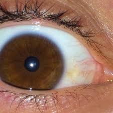 War Ofter Feiern Kommt Dieser Gelbe Stich Im Auge Vom Alkohol Trinke Eigentlich Nie Extrem Viel Gesundheit Und Medizin Gesundheit Medizin