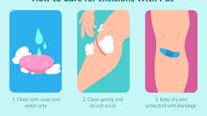 Caring for a sutured or stapled wound after 48 hours, clean the area with mild soap and water twice a day or as indicated by your doctor. Pus Types Causes Treatment Prevention