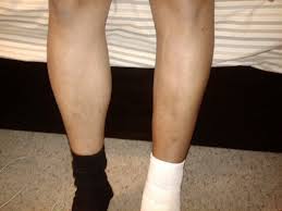 Pictures of muscle atrophy in legs. Muscle Atrophy And Its Different Causes