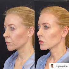 before and after photos of my filler treatment