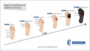 Image result for IDSA Diabetic Foot Wound Classification