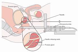 Hifu And Prostate Cancer