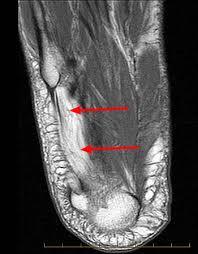 Muscle injuries of the hip and thigh are a highly relevant issue in competitive sports imaging. Baxter S Nerve First Branch Of The Lateral Plantar Nerve Impingement Radsource