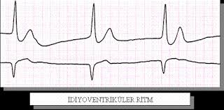 Nabızsız elektriksel aktivite (nea) varsa geri döndürülebilir durumları gözden geçir.hipovolemi, hipoksi, hidrojen iyonu (asidoz), hiperkalemi / hipokalemi, hipotermi, tablet (istemli ya da kaza ile aşırı ilaç alımı), tamponad (kardiyak), tansiyon pnömotoraks, tromboz, koroner (akut koroner sendrom, myokard enfarktüsü), tromboz. Https Www Atuder Org Tr Fileout Aspx Url Cwvmlwqpvvrlaofr1kwz