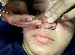 Untuk meningkatkan peremajaan kulit, membantu mengecilkan pori wajah dan . Laser Sebagai Cara Merawat Wajah