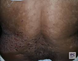 Image result for Postinflammatory Hypopigmentation