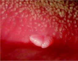 Vestibular Papillomatosis Vs. Hpv | Vestibular Papillomatosis | Everlywell