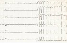 Let's embark on a journey of marriage, shall we? Ecg Ekg Examples And Quiz Oxford Medical Education
