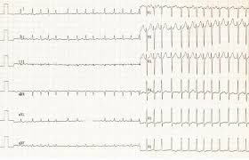 We've got 11 questions—how many will you get right? Ecg Ekg Examples And Quiz Oxford Medical Education