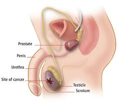 Testicular cancer is the most common cancer in men aged 20 to 35. About Testicular Cancer Dana Farber Cancer Institute Boston Ma