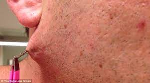 Ingrown hair is a condition where a hair curls back or grows sideways into the skin. Man Pulls World S Longest Ingrown Hair Out Of His Face Daily Mail Online