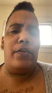 I born with tuner syndrome...