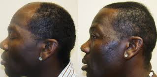 So i have been taking biotin for my hair loss. My Hair Rescue Experience How I Stopped Baldness Benefits Of Spirulina Powder For Hair Regrowth Spirulina Powder For Hair Regrowth Mask Benefits Spirulina Mask Nigeria The Best Product For Hair Restoration
