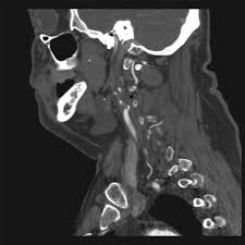 Image result for Jaw Claudication