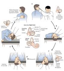 Image result for Canalith Repositioning Procedure