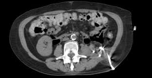 Image result for Perinephric Abscess