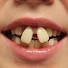 Discover the most modern transparent aligner system worldwide and transform your smile. 1
