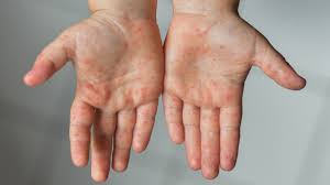 Cold hands and feet, which can a sign of an underlying medical condition, can be treated effectively with natural remedies like cayenne pepper while having cold hands or feet is generally a part of the body's natural response to regulate and control the body temperature, persistently cold extremities. Hand Foot And Mouth Disease Children Raising Children Network