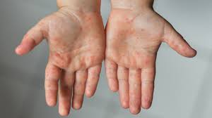 hand foot and mouth disease children