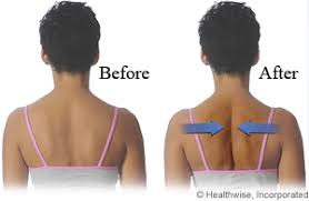 Image result for Shoulder Subluxation