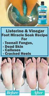 Listerine Foot Remedies Feet Care Listerine