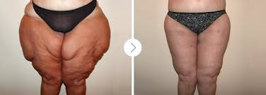 عملية شد الجسم من الجوانب أو شد جوانب الفخذين الخارجية