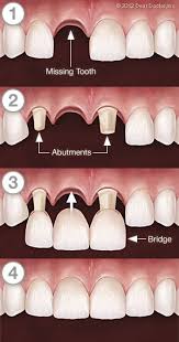 Bridgework Step By Step Dental Crowns Dental Implants Cost Dentistry