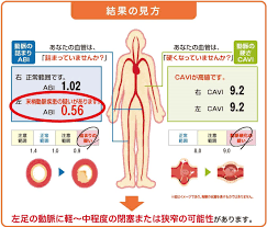 検査部コラム 血圧脈波検査について紹介します | 広報誌「高松日赤だより なんがでっきょんな」 | 高松赤十字病院 - 日本赤十字社 [香川県]