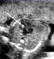 Soft Markers Fetal Ultrasound