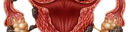 Meist ist das gewebe und die organe in unmittelbarer nähe der gebärmutter. Endometriose