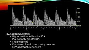 Pin By Maria On Ultrasound Vascular Ultrasound Ultrasound Sonography Ultrasound