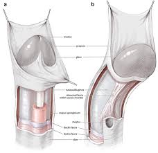 Image result for Chordee