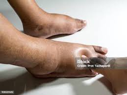 Image result for toe black diabetes
