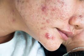 Image result for acne face