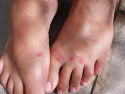 The american academy of allergy, asthma & immunology note that it may take as long as 18 months or more for a. What Happens After A Mosquito Bite Sigma Pest Control