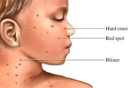 Chicken pox what is chicken pox chicken pox scars chicken pox rash chicken pox symptoms chicken pox treatment chicken pox vaccine how to cure chicken pox how to treat chicken pox how to get rid of chicken pox chicken pox diet chicken pox home remedies natural treatment for. Facebook