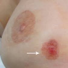 Sometimes the symptoms of skin metastases, such as redness and inflammation, may look like an infection of the skin called cellulitis. Recurrence Of Breast Carcinoma As Paget Disease Of The Skin At A Prior Core Needle Biopsy Site Case Report And Review Of The Literature Sciencedirect