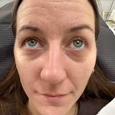 TEAR TROUGH FILLER 😍 Such an improvement (mild swelling).