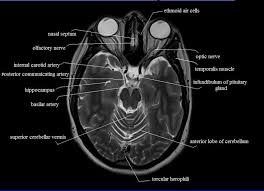 Cross Sectional Anatomy Mri Brain 10 Jpg 800 578 Mri Brain Brain Anatomy Radiology