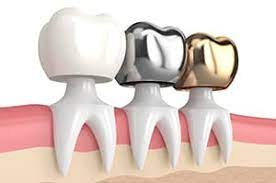 Maybe you would like to learn more about one of these? Types Of Dental Crowns And Cost A Complete Guide 2021