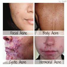Back Acne And Neck Acne Get Rid Of It Quickly And Permanently Pimples On Neck And Jawline Acnescars Neck Acne Cystic Acne Treatment Cystic Acne Remedies