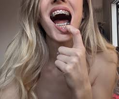 Hi Im Andie and I have a braces fetish 🙋🏼‍♀️ : rBracesPorn