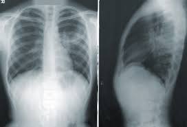 • 60 a 79 • igual o mayor de 80 trombosis profunda o tromboembolia previa cirugía reciente, en menos de un mes frecuencia cardíaca superior a 100 radiografía de tórax: Detectar A Tiempo Una Embolia Pulmonar En Los Enfermos Con Covid 19 Puede Mejorar Su Recuperacion Trombo
