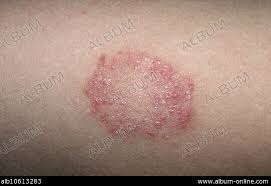 Image result for Eczema nummulare