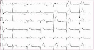 Image result for Lyme Carditis