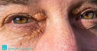 Image result for xanthelasma of eyelid