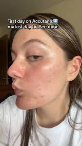 Accutane Journey: Before and After Results