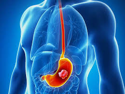 Other signs and symptoms of stomach cancer in children include nausea, vomiting. Medical Second Opinion Medisense Healthcare Solutions